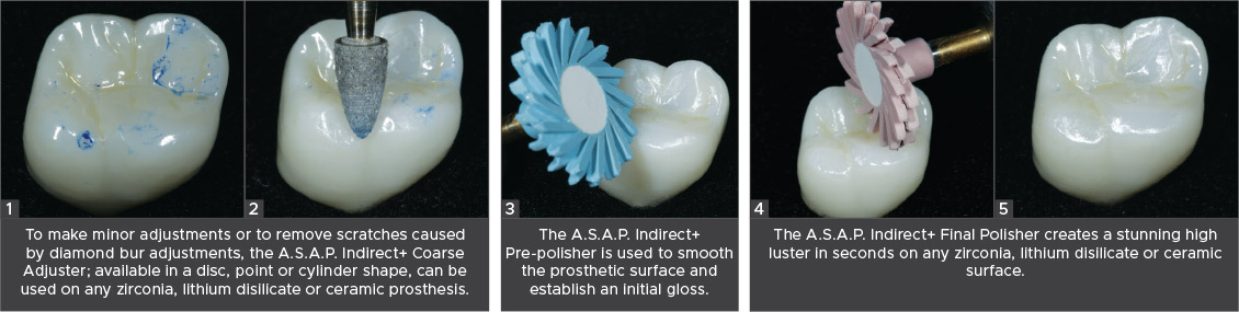 ASAP-Indirect+-Clinical-Technique A.S.A.P. Indirect Clinical Technique
