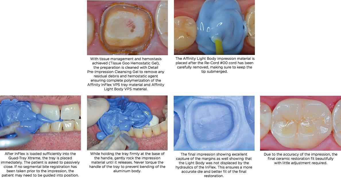 Affinity-InFlex-Dual-Arch-Impressions Affinity InFlex Dual Arch Impression