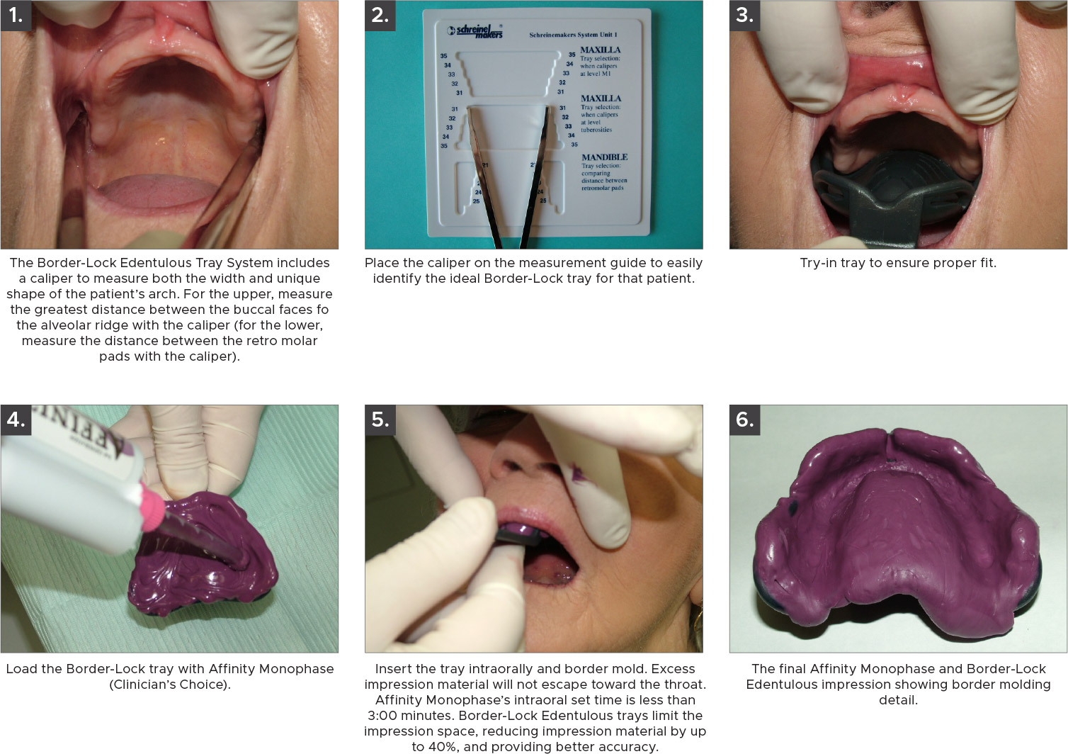 Border Lock ET Edentulous Impression Tray System