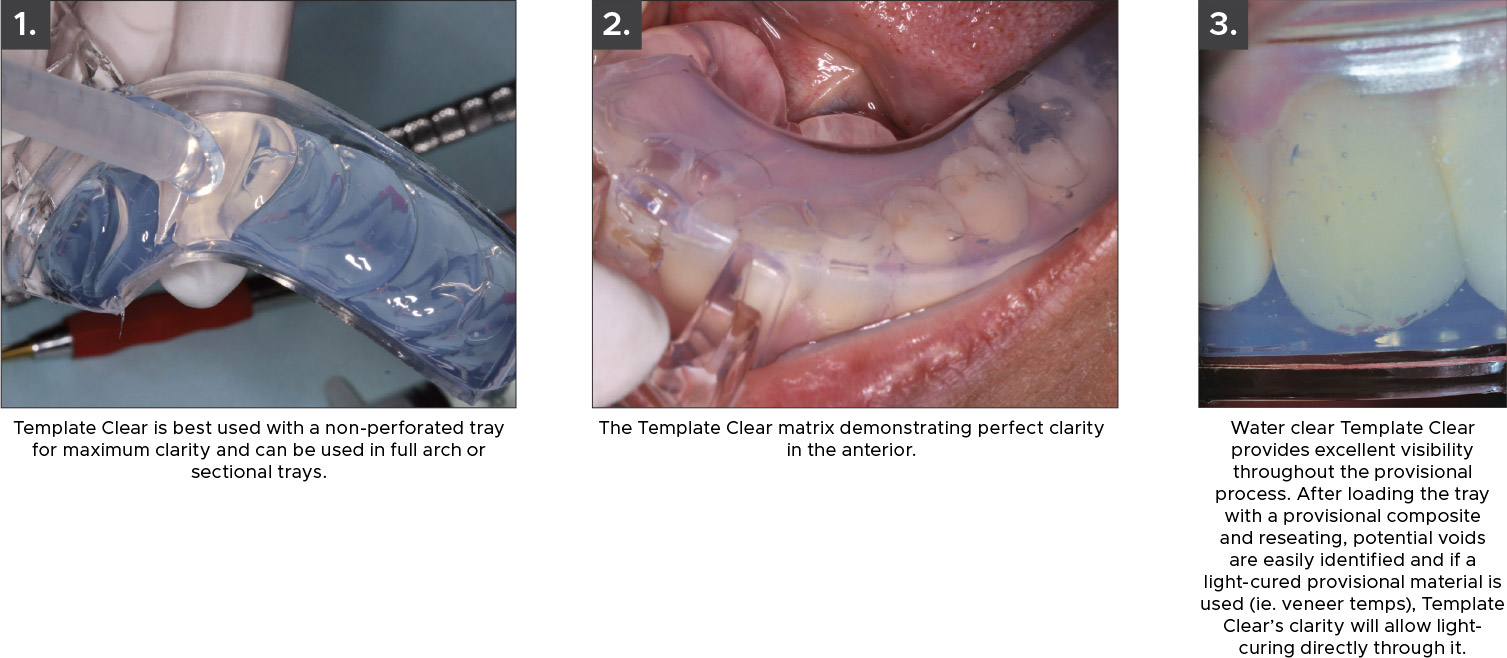 Clear-Impression-Trays-Clinical-Technique Clear Impression Trays Clinical Tec