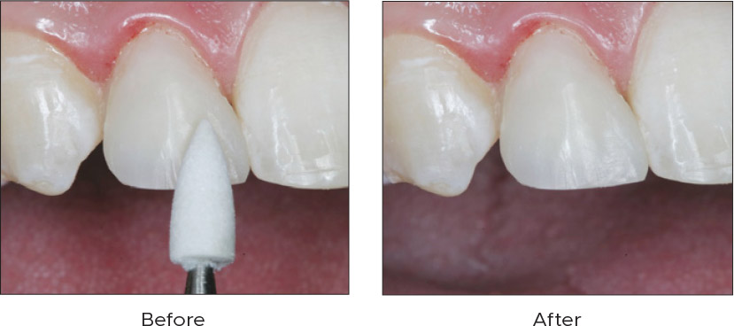 Contours-Coarse-Anatomy-Trimmer-Before-After Contours Coarse Anatomy Trimmers Before & After