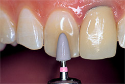 D-Fine-Diamond-Polisher-Pink D-Fine Diamond Polisher Clinical Techniques