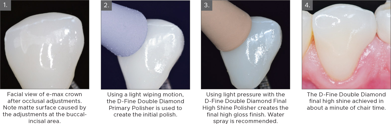 D-Fine-Double-Diamond-Clinical-Technique D-Fine Double Diamond Polishing System Clinical Technique