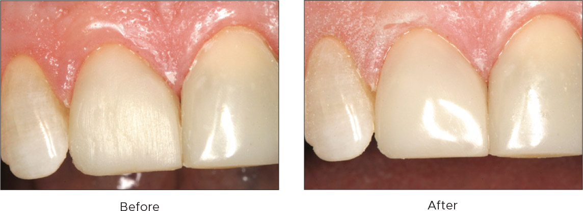 D-Fine-Shape-&-Shine-Clinical-Techique D-Fine Shape & Shine Clinical Technique