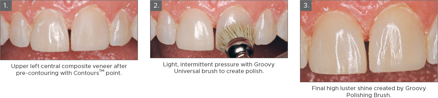 Groovy-Diamond-Clinical-Technique Groovy Diamond Polishing Brushes Clinical Technique