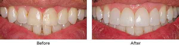 Inspire-Complete-Provisional-System-Before-After Inspire Complete Provisional System Before and After