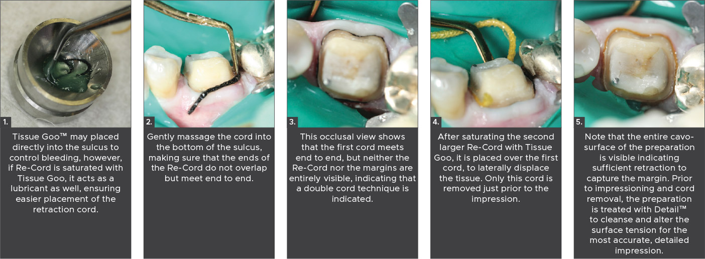 Tissue-Goo-Clinical-Technique Tissue Goo Hemostatic Gel Clinical Technique