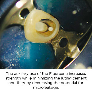 Fibercone Clinical Technique