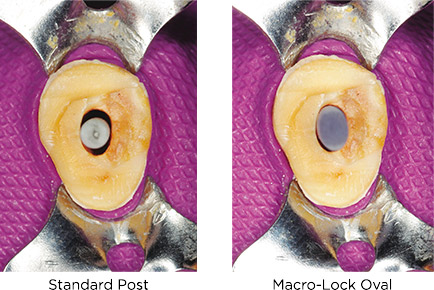 Macro-Lock-Oval-Clinical-Technique Clinician's Choice Macro-Lock Oval
