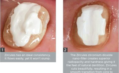 Zircules-Core-Buildup Zircules Core Build-up