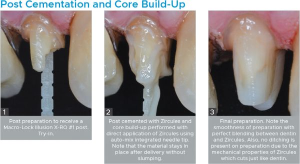 Zircules-Post-Cementation Zircules Post Cementation and Core Build-up