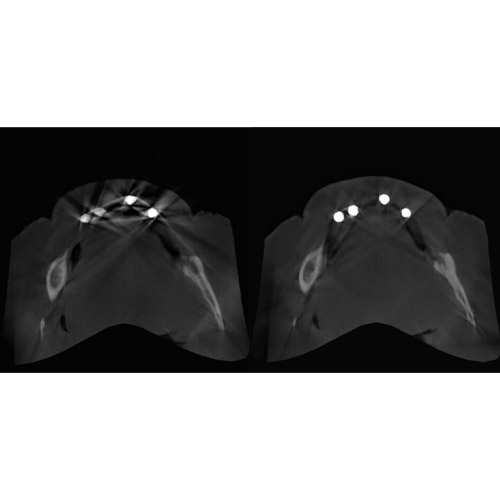 Durr Dental 3D Metal Artefact