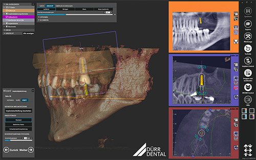 Durr Dental VistaSoft Implant