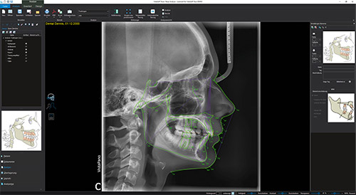 Durr Dental VistaSoft Trace