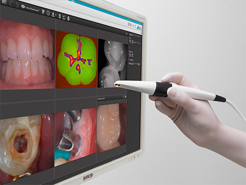 Durr Dental VistaSoft Video