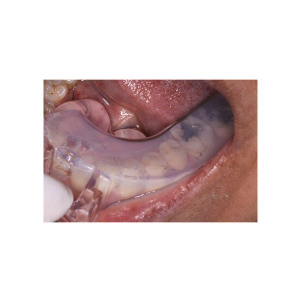 Clinician's Choice Impression Trays Disposable Clear Quadrant Upper Left Lower Right (25)