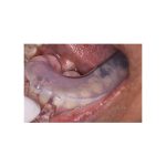 Clinician's Choice Impression Trays Disposable Clear Quadrant Upper Right Lower Left (25)