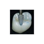 Clinician's Choice A.S.A.P. Indirect+ Intraoral Polishers Point Adjusters RA (3)