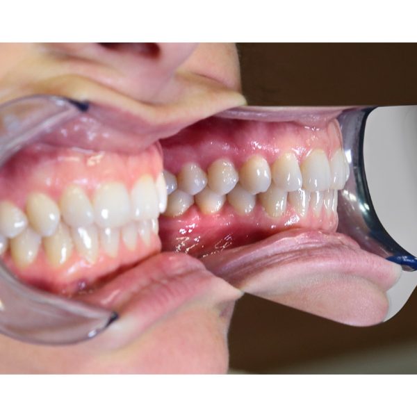 Medesy Photographic Mirror Occlusal No. 10 70mm x 165mm (WxL)