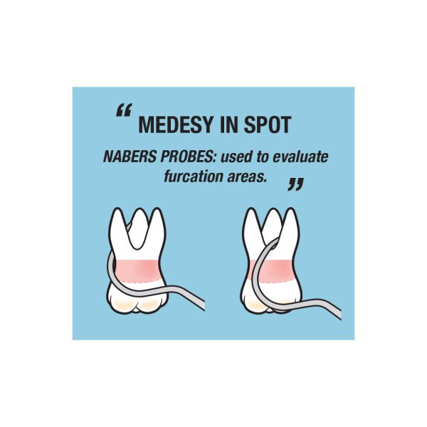 Medesy Periodontal Probe Nabers No. 2N Colour Coded