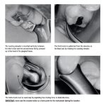 Medesy Luxating Instrument Lussatore for Upper Third Molar