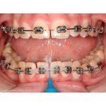 TePe Interdental Brushes Original ISO Size 3 Wire Size 0.60mm Blue (25)