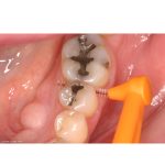 TePe Angle Interdental Brushes ISO Size 1 Wire Size 0.45mm Orange (25)