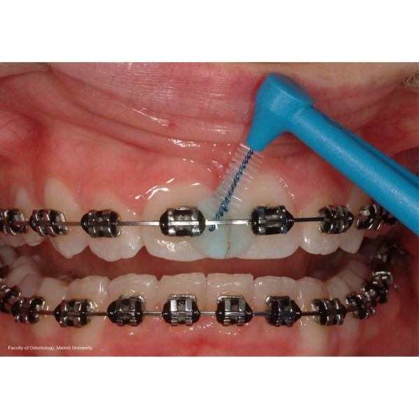 TePe Angle Interdental Brushes ISO Size 3 Wire Size 0.60mm Blue (25)