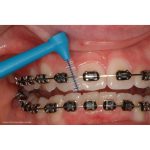 TePe Angle Interdental Brushes ISO Size 3 Wire Size 0.60mm Blue (25)