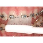 TePe Implant Orthodontic Toothbrush Individually Wrapped