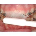 TePe Implant Orthodontic Toothbrush Individually Wrapped