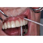 TePe Bridge & Implant Floss Samples (100)