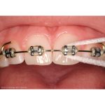 TePe Bridge & Implant Floss Samples (100)