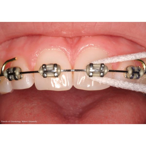 TePe Bridge & Implant Floss Samples (100)