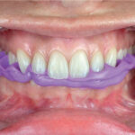 Zhermack Occlufast Rock Bite Registration 50ml Cartridge (2)