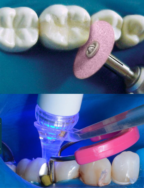 TDV-Restorations-Finishing-&-Polishing TDV Restorations, Finishing & Polishing