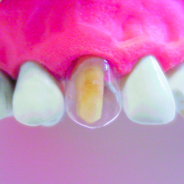 TDV Transparent Crowns Deciduous Anterior & Posterior Crown Kit (64)