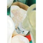 TDV Contact + Gold Instrument (2)